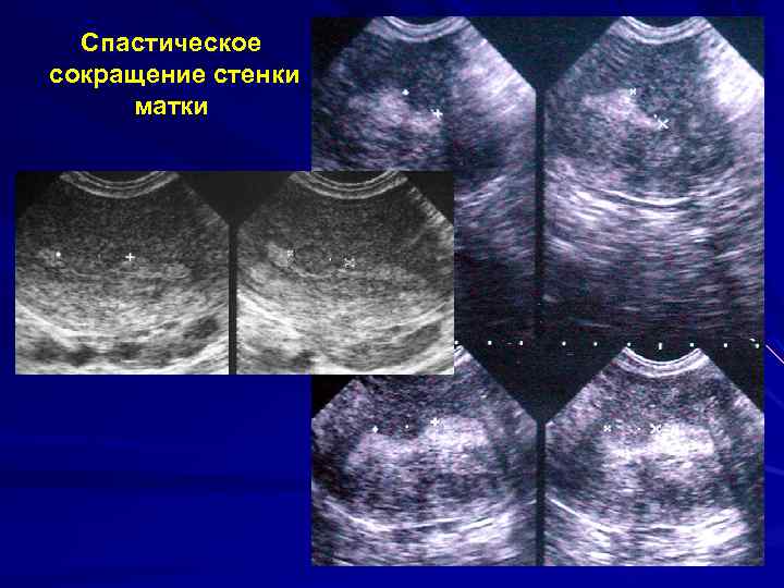 Спастическое сокращение стенки матки 