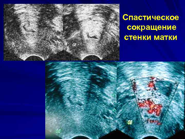 Спастическое сокращение стенки матки 