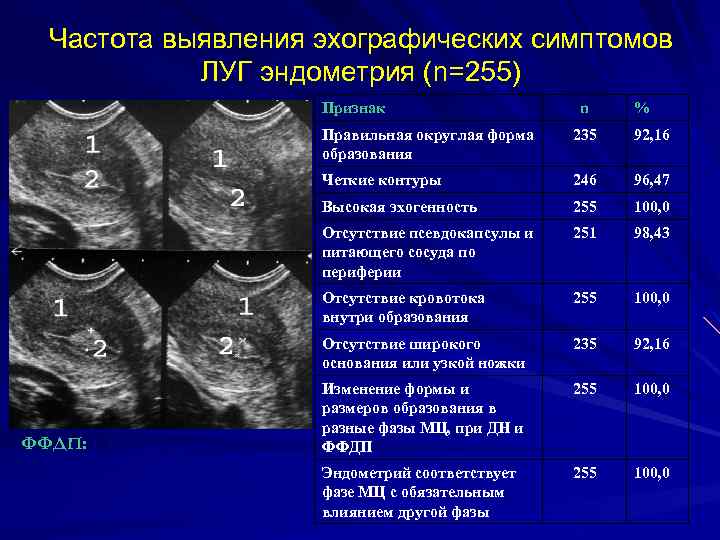 Частота выявления эхографических симптомов ЛУГ эндометрия (n=255) Признак n % Правильная округлая форма образования