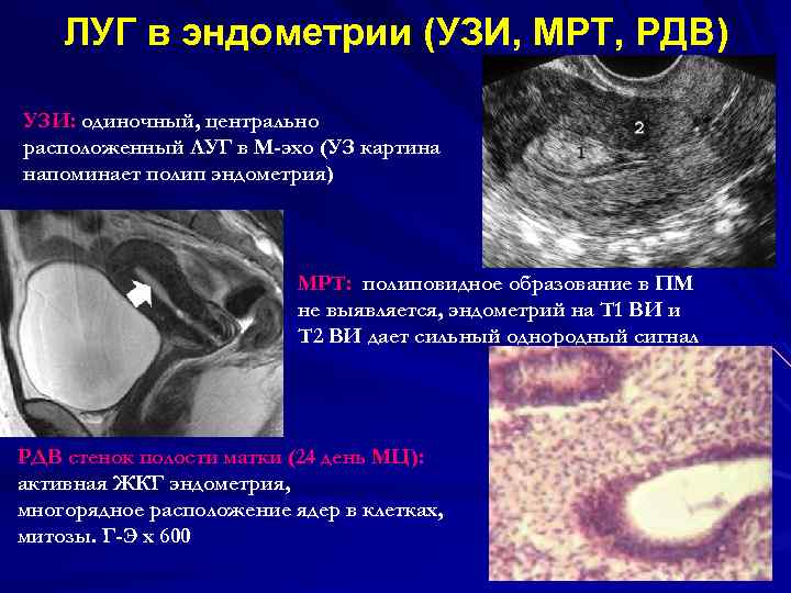 ЛУГ в эндометрии (УЗИ, МРТ, РДВ) УЗИ: одиночный, центрально расположенный ЛУГ в М-эхо (УЗ