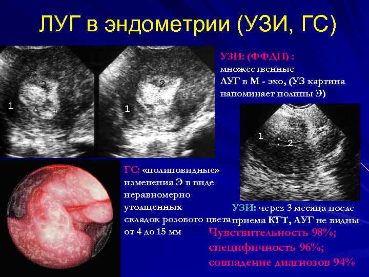 ЛУГ в эндометрии (УЗИ, ГС) УЗИ: (ФФДП) : множественные ЛУГ в М - эхо,