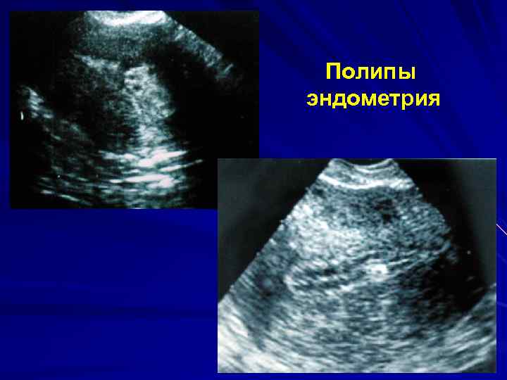 Полипы эндометрия 