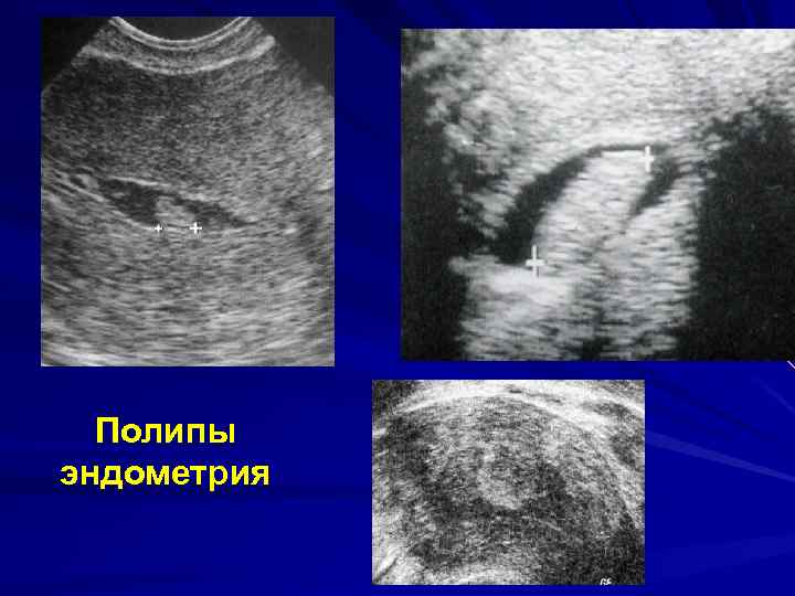 Полипы эндометрия 