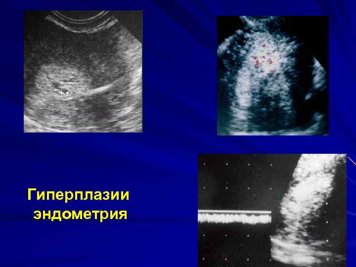 17 опк при гиперплазии эндометрия схема приема