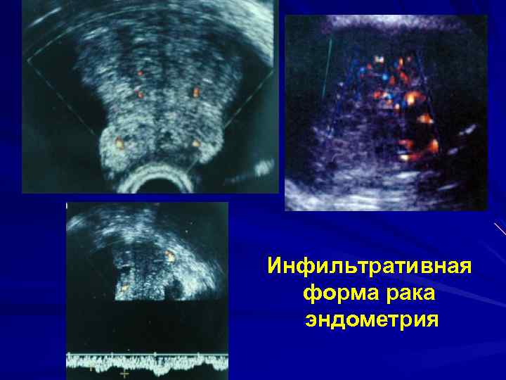 Инфильтративная форма рака эндометрия 