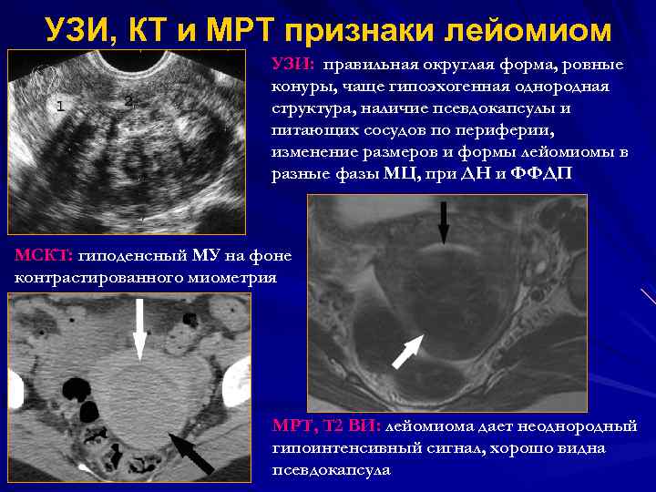 УЗИ, КТ и МРТ признаки лейомиом УЗИ: правильная округлая форма, ровные конуры, чаще гипоэхогенная