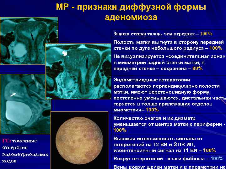 МР - признаки диффузной формы аденомиоза Задняя стенка толще, чем передняя – 100% Полость