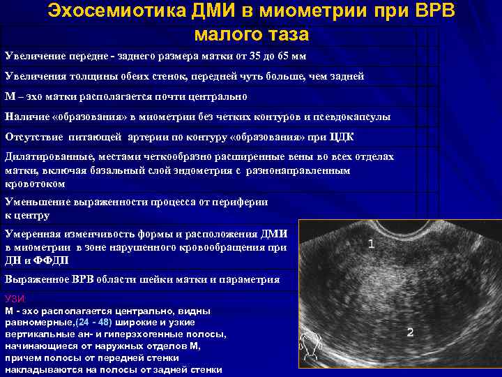 Эхосемиотика ДМИ в миометрии при ВРВ малого таза Увеличение передне - заднего размера матки