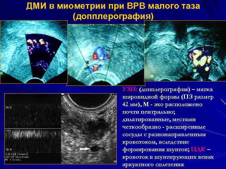 ДМИ в миометрии при ВРВ малого таза (допплерография) УЗИ: (допплерография) – матка шаровидной формы