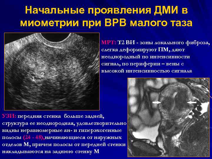 Начальные проявления ДМИ в миометрии при ВРВ малого таза МРТ: Т 2 ВИ -