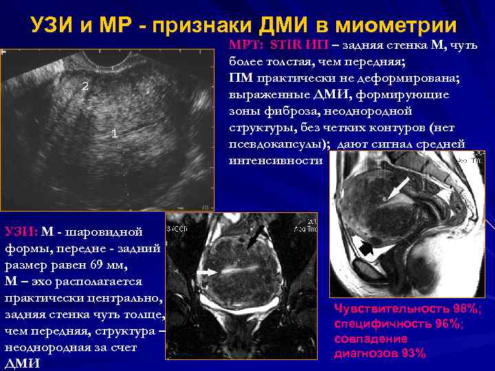 УЗИ и МР - признаки ДМИ в миометрии МРТ: STIR ИП – задняя стенка
