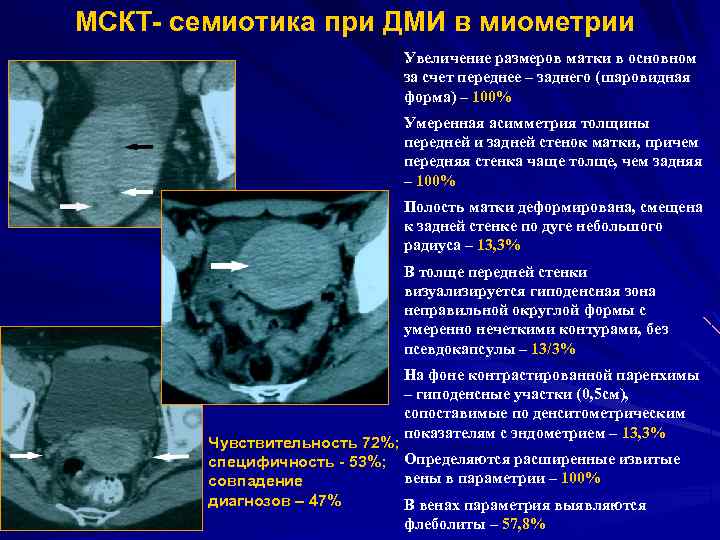 МСКТ- семиотика при ДМИ в миометрии Увеличение размеров матки в основном за счет переднее