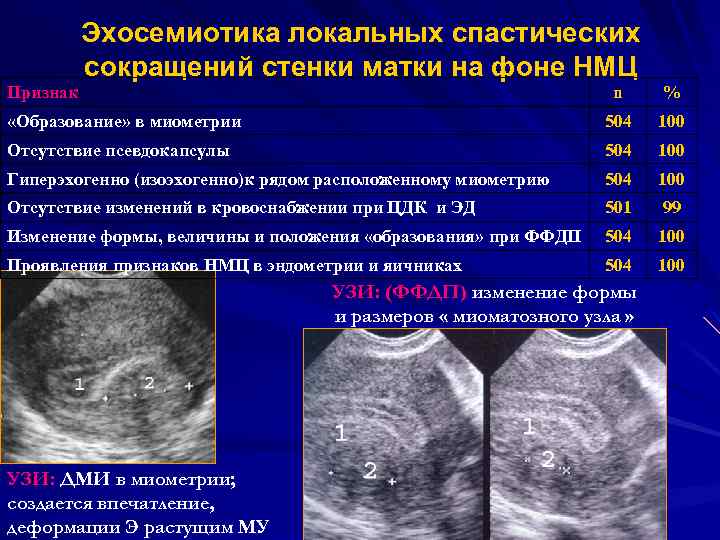 Образование в матке. Гипертонус миометрия на УЗИ. Локальное утолщение миометрия. Локальный гипертонус миометрия.