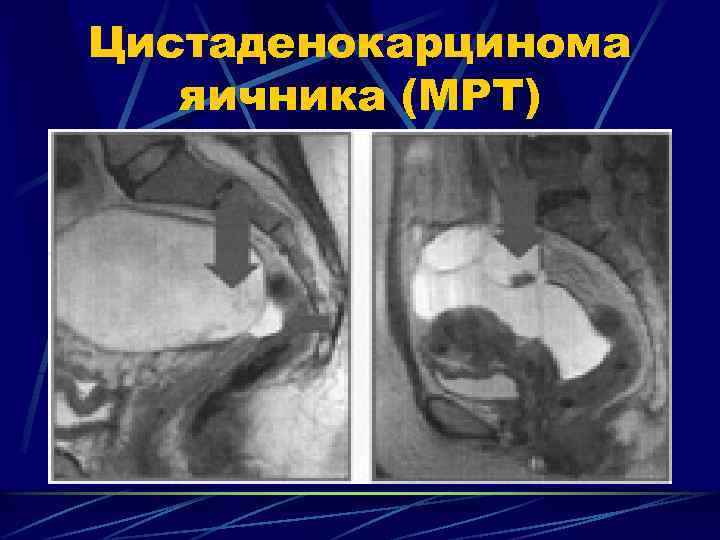 Цистаденокарцинома яичника (МРТ) 