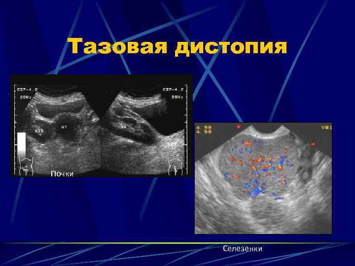 2 в яичниках образуются. Тазовая дистопия почки УЗИ. Дистопия селезенки на УЗИ. Тазовая дистопия правой почки на УЗИ.