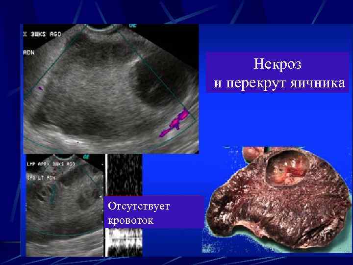 Некроз и перекрут яичника Отсутствует кровоток 