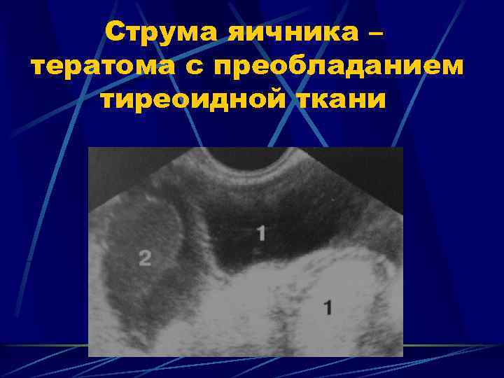 Струма яичника – тератома с преобладанием тиреоидной ткани 