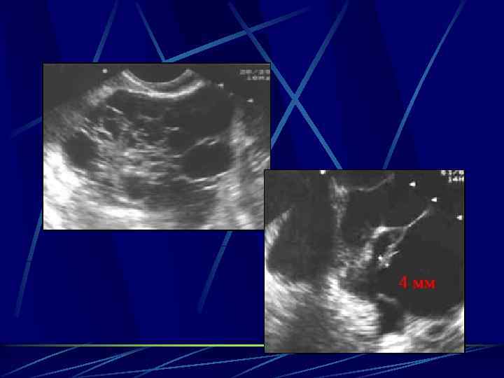 Мелкодисперсного образование яичника это. Целующиеся яичники на УЗИ.