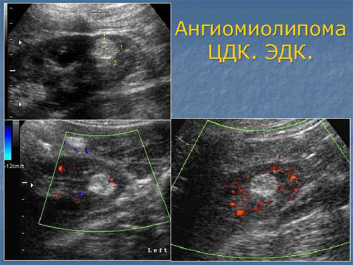 Ангиомиолипома почки