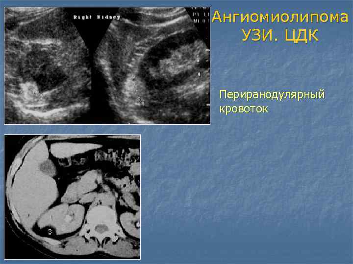 Ангиомиолипома почки что