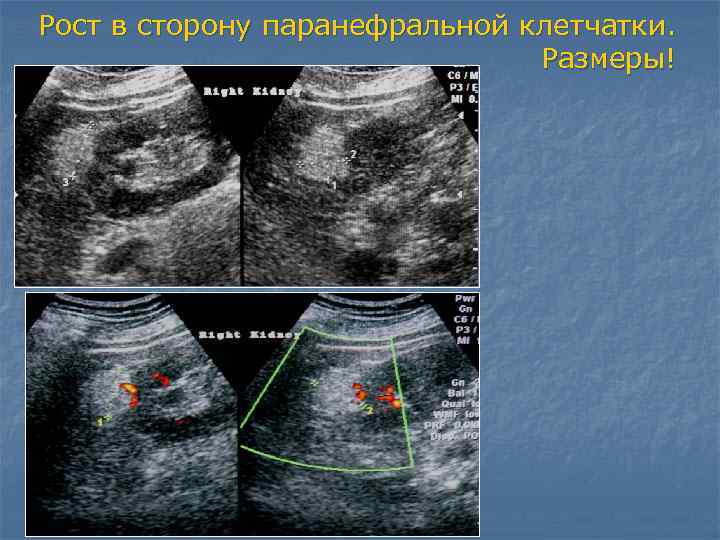 Отек клетчатки. Паранефральная клетчатка тяжиста.. Паранефральная клетчатка кт. Отек паранефральной клетчатки на УЗИ. Паранефральная клетчатка на УЗИ.