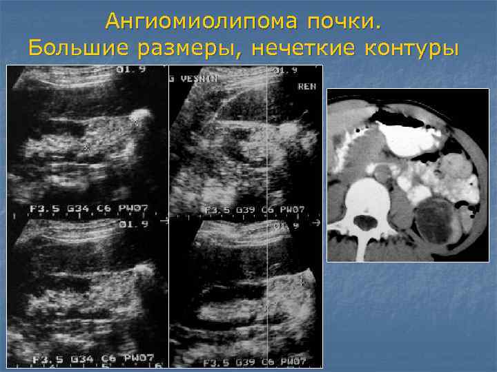 Ангиомиолипома. Ангиомиолипома почки кт признаки. Ангиомиолипомы почек на кт.