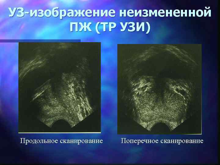 УЗ-изображение неизмененной ПЖ (ТР УЗИ) Продольное сканирование Поперечное сканирование 