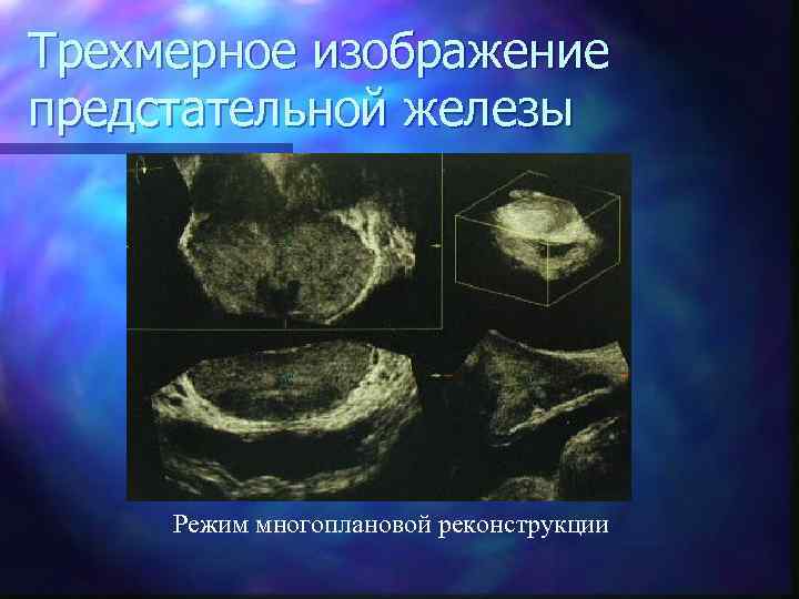 Трехмерное изображение предстательной железы Режим многоплановой реконструкции 