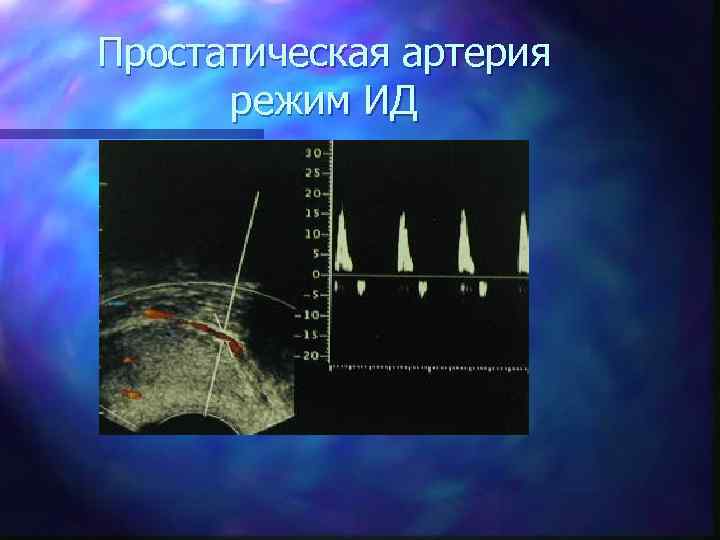 Простатическая артерия режим ИД 