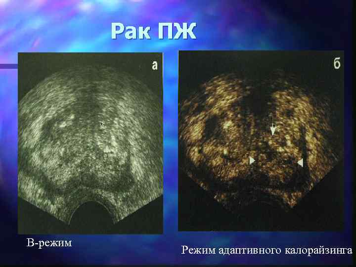 Рак ПЖ B-режим Режим адаптивного калорайзинга 