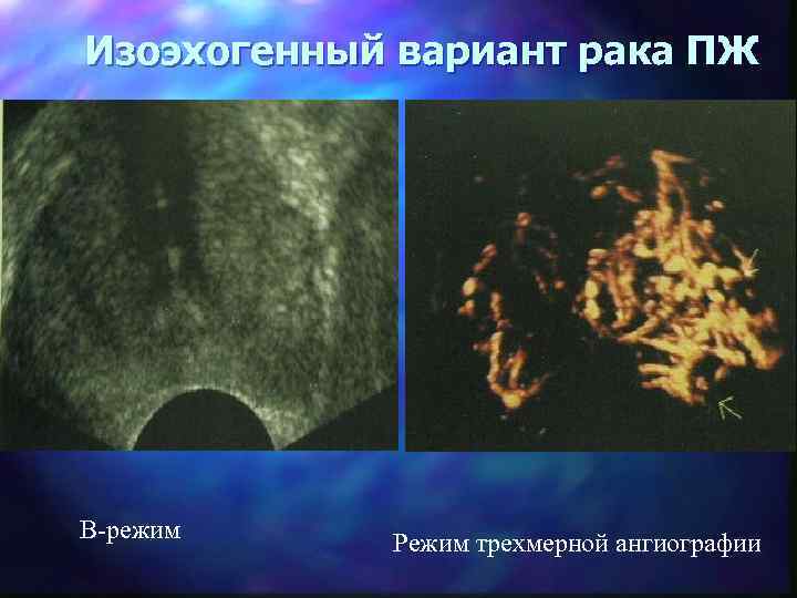 Изоэхогенный вариант рака ПЖ В-режим Режим трехмерной ангиографии 