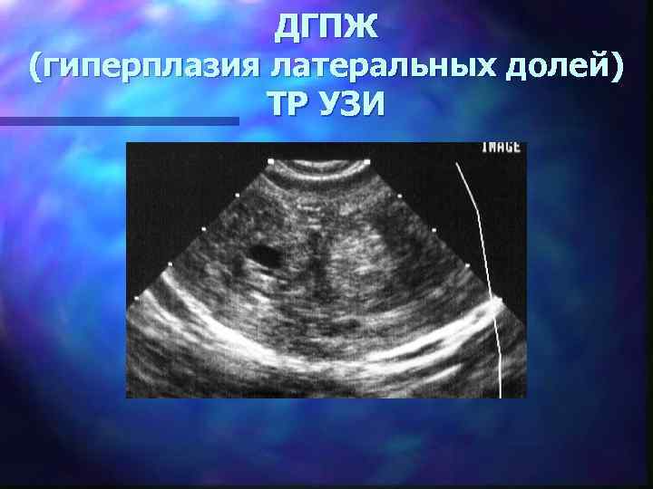 ДГПЖ (гиперплазия латеральных долей) ТР УЗИ 