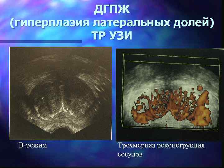 ДГПЖ (гиперплазия латеральных долей) ТР УЗИ В-режим Трехмерная реконструкция сосудов 