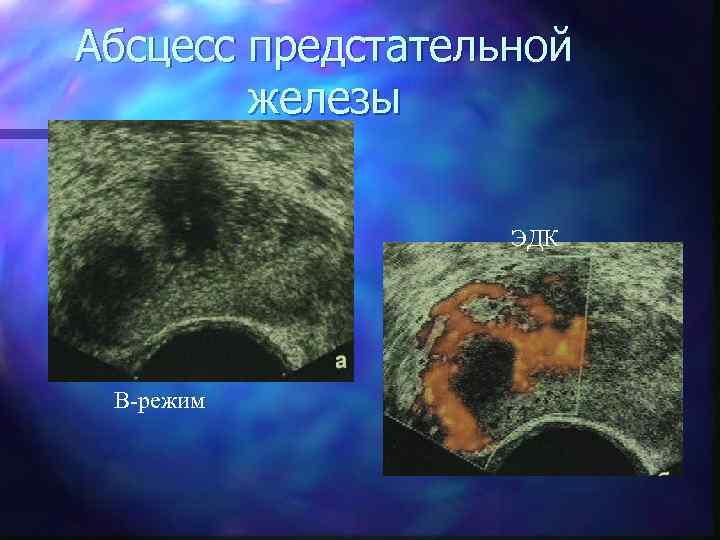 Абсцесс предстательной железы ЭДК В-режим 