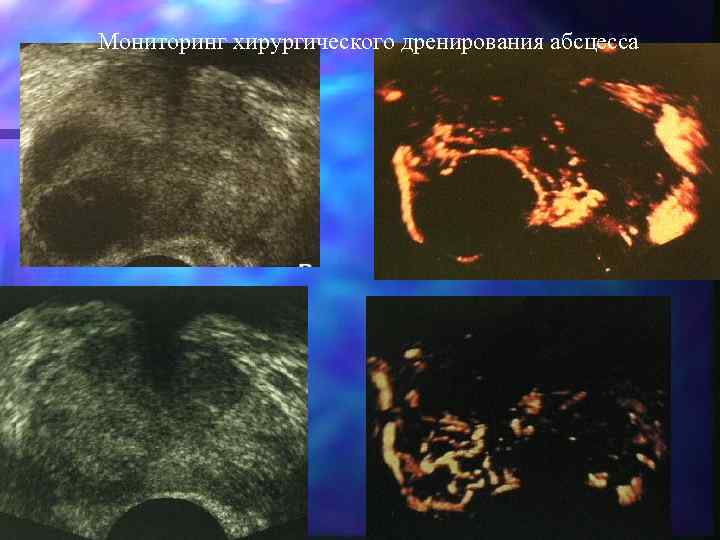 Мониторинг хирургического дренирования абсцесса 