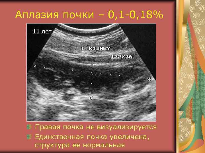 Аплазия почки – 0, 1 -0, 18% 11 лет Правая почка не визуализируется Единственная
