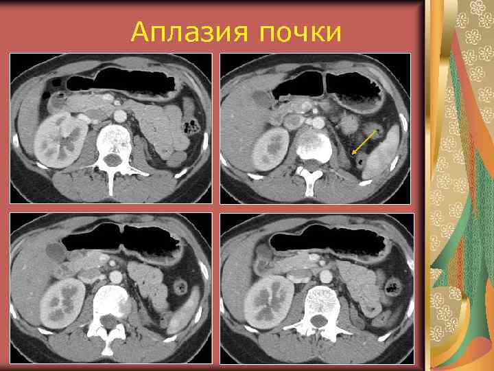 Аплазия почки 