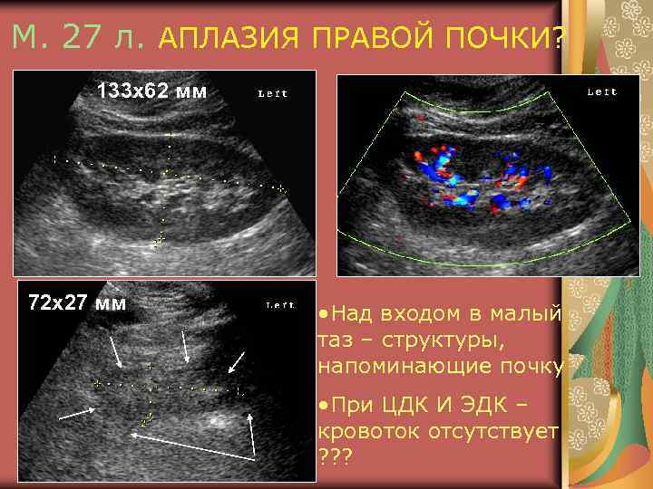 М. 27 л. АПЛАЗИЯ ПРАВОЙ ПОЧКИ? 133 х62 мм 72 х27 мм • Над