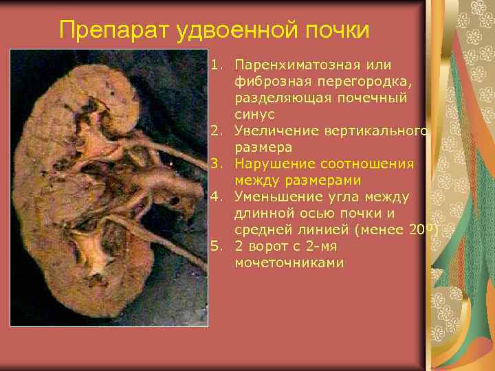 Препарат удвоенной почки 1. Паренхиматозная или фиброзная перегородка, разделяющая почечный синус 2. Увеличение вертикального
