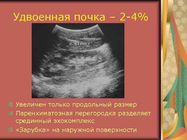 Удвоенная почка – 2 -4% Увеличен только продольный размер Паренхиматозная перегородка разделяет срединный эхокомплекс