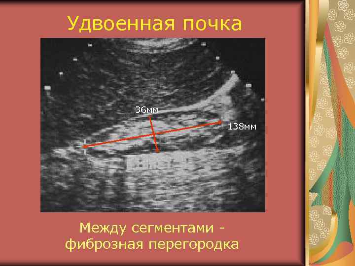 Удвоенная почка 36 мм 138 мм Между сегментами фиброзная перегородка 