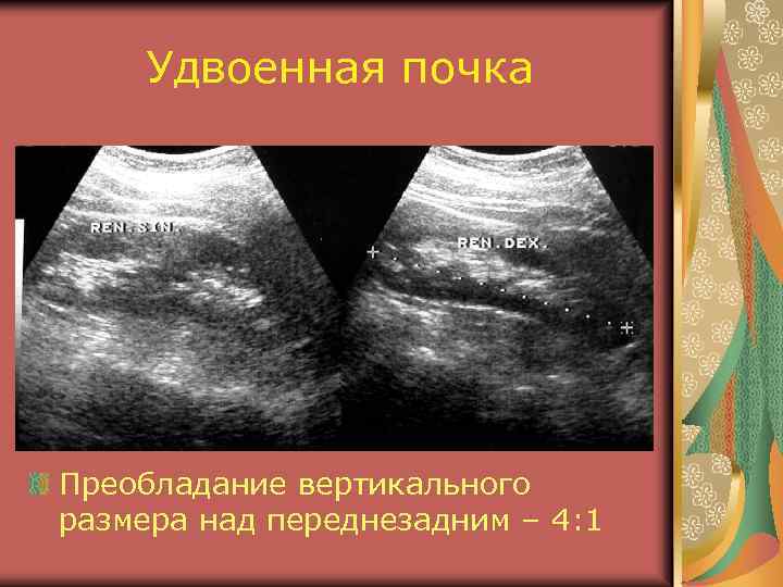 Удвоенная почка Преобладание вертикального размера над переднезадним – 4: 1 