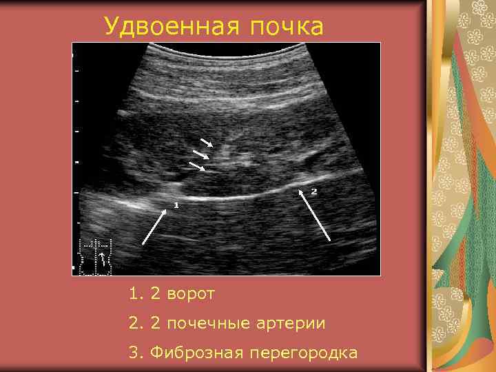 Удвоенная почка 1. 2 ворот 2. 2 почечные артерии 3. Фиброзная перегородка 