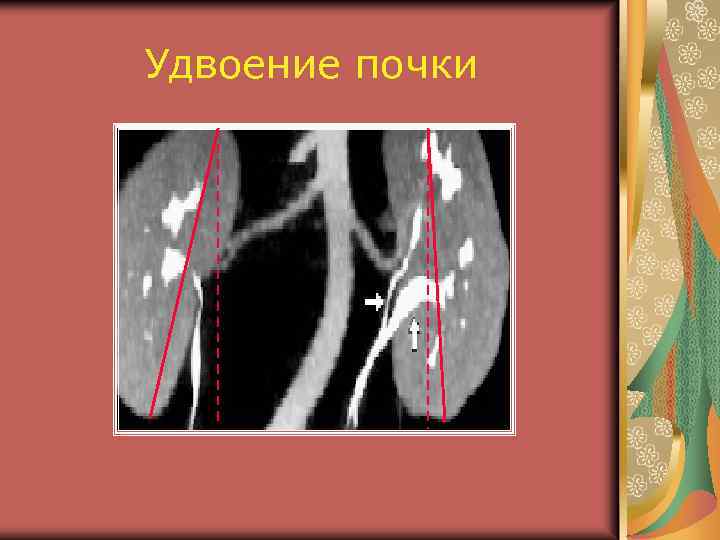 Удвоение почки 