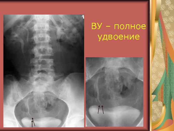 ВУ – полное удвоение 