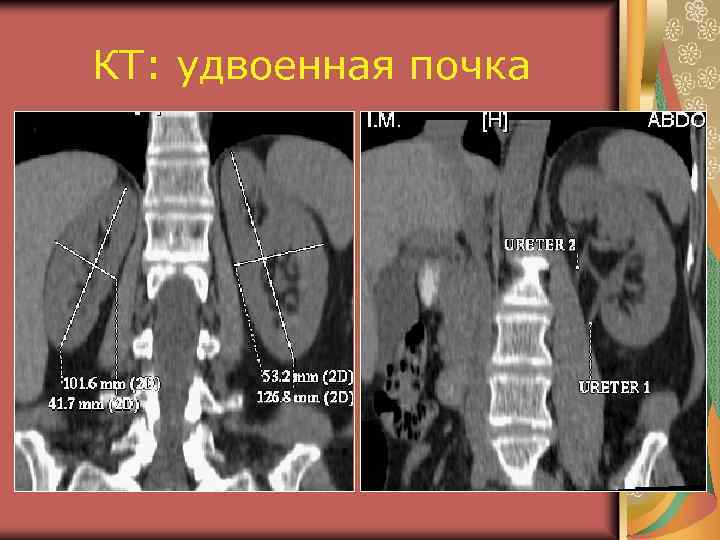 КТ: удвоенная почка 