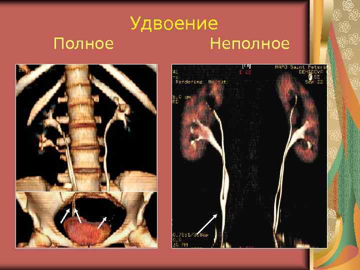 Полное Удвоение Неполное 