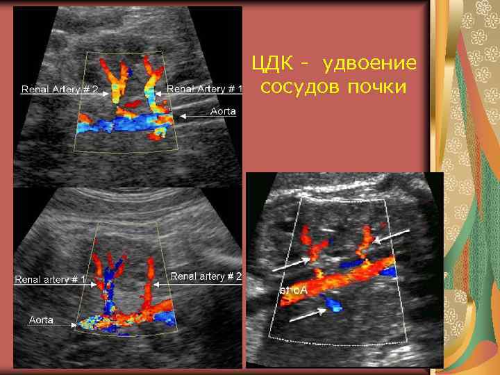 ЦДК - удвоение сосудов почки 