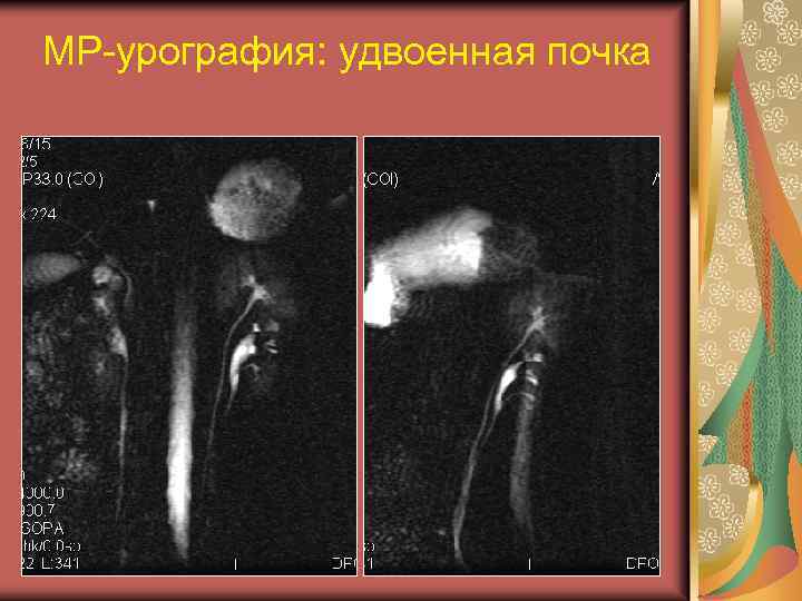 МР-урография: удвоенная почка 