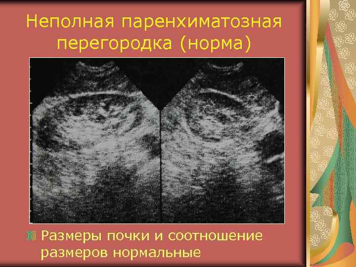 Неполная паренхиматозная перегородка (норма) Размеры почки и соотношение размеров нормальные 